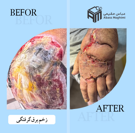 زخم برق گرفتگی