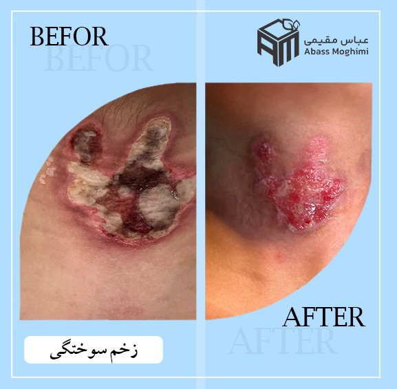 زخم سوختگی
