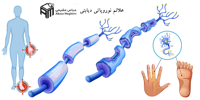 علایم نوروپاتی دیابتی