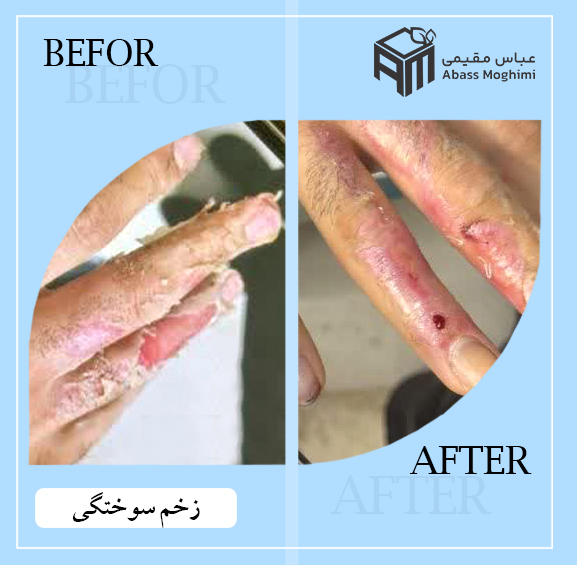 زخم سوختگی