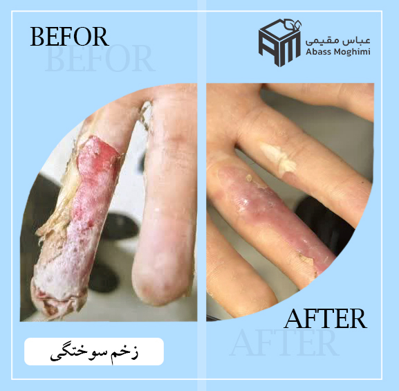 زخم سوختگی